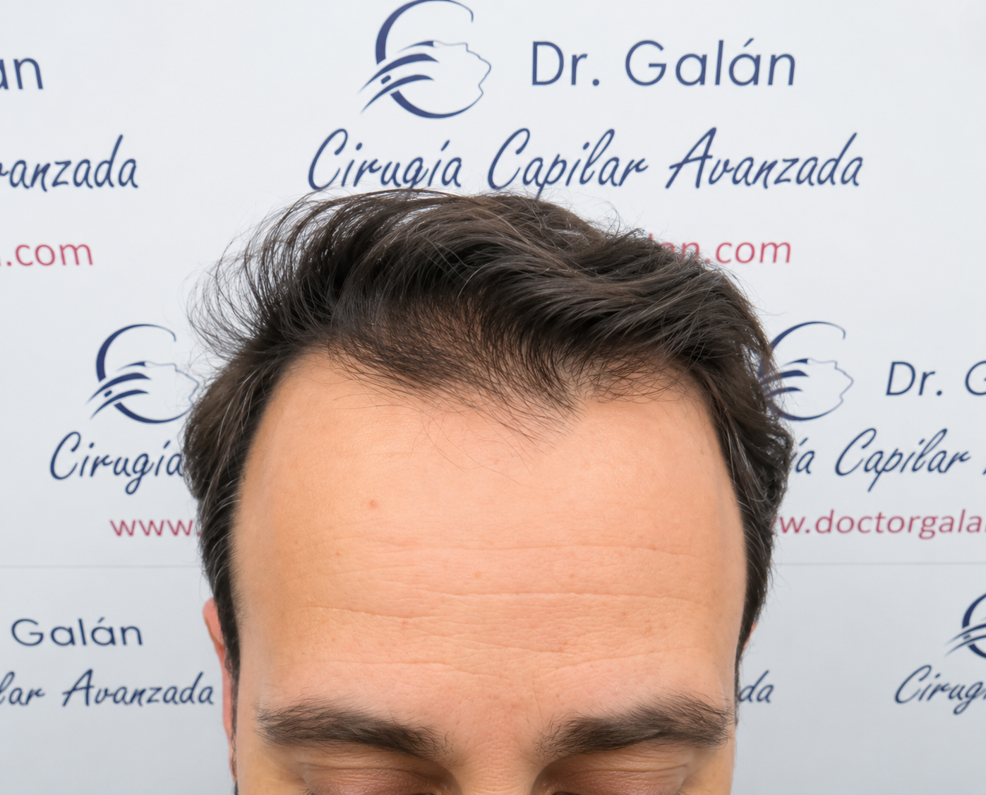 Trasplante Capilar en Málaga: Guía Completa 2026
