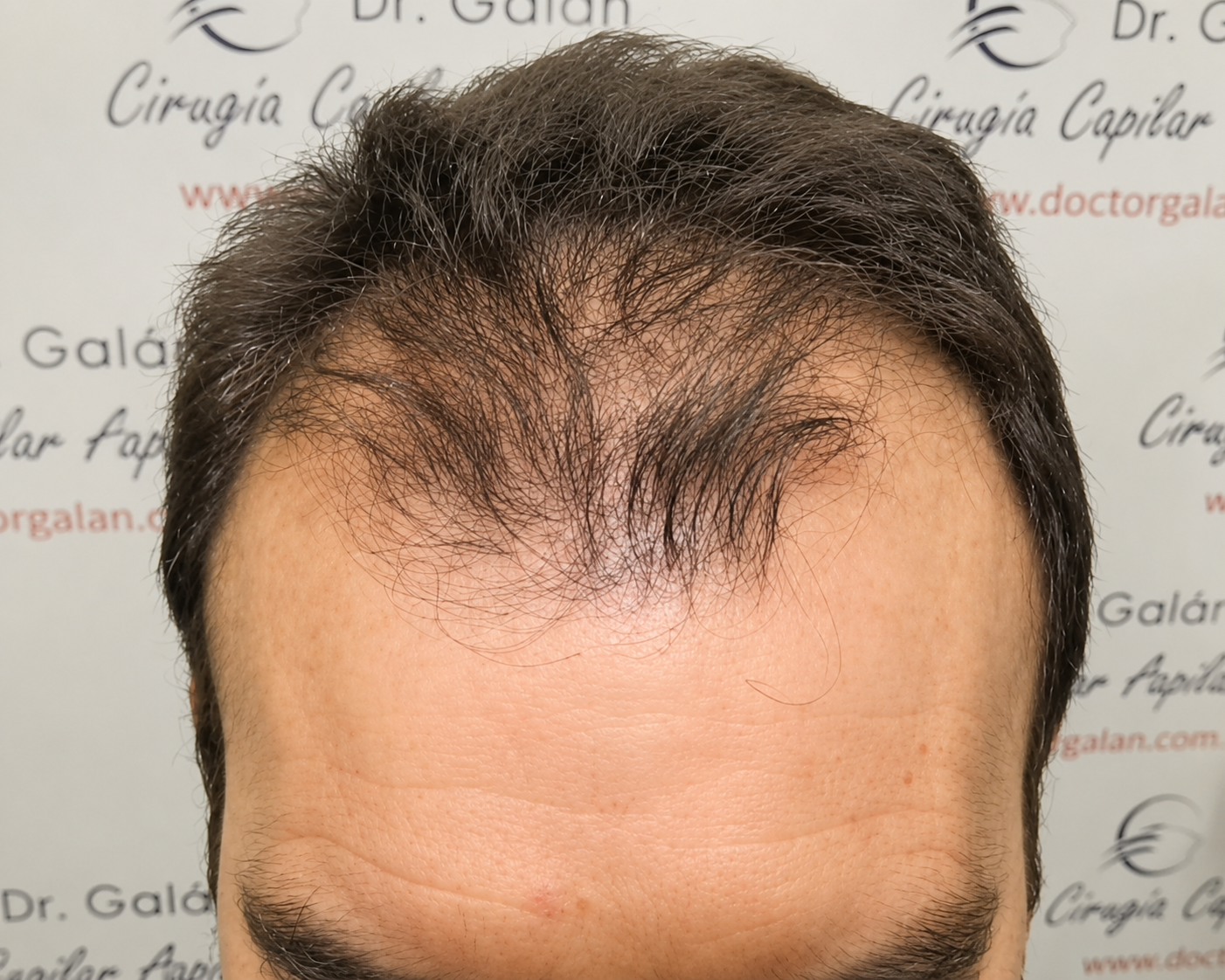 Alopecia Androgenética: Tratamiento y Soluciones
