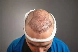 Cirugía de avance capilar